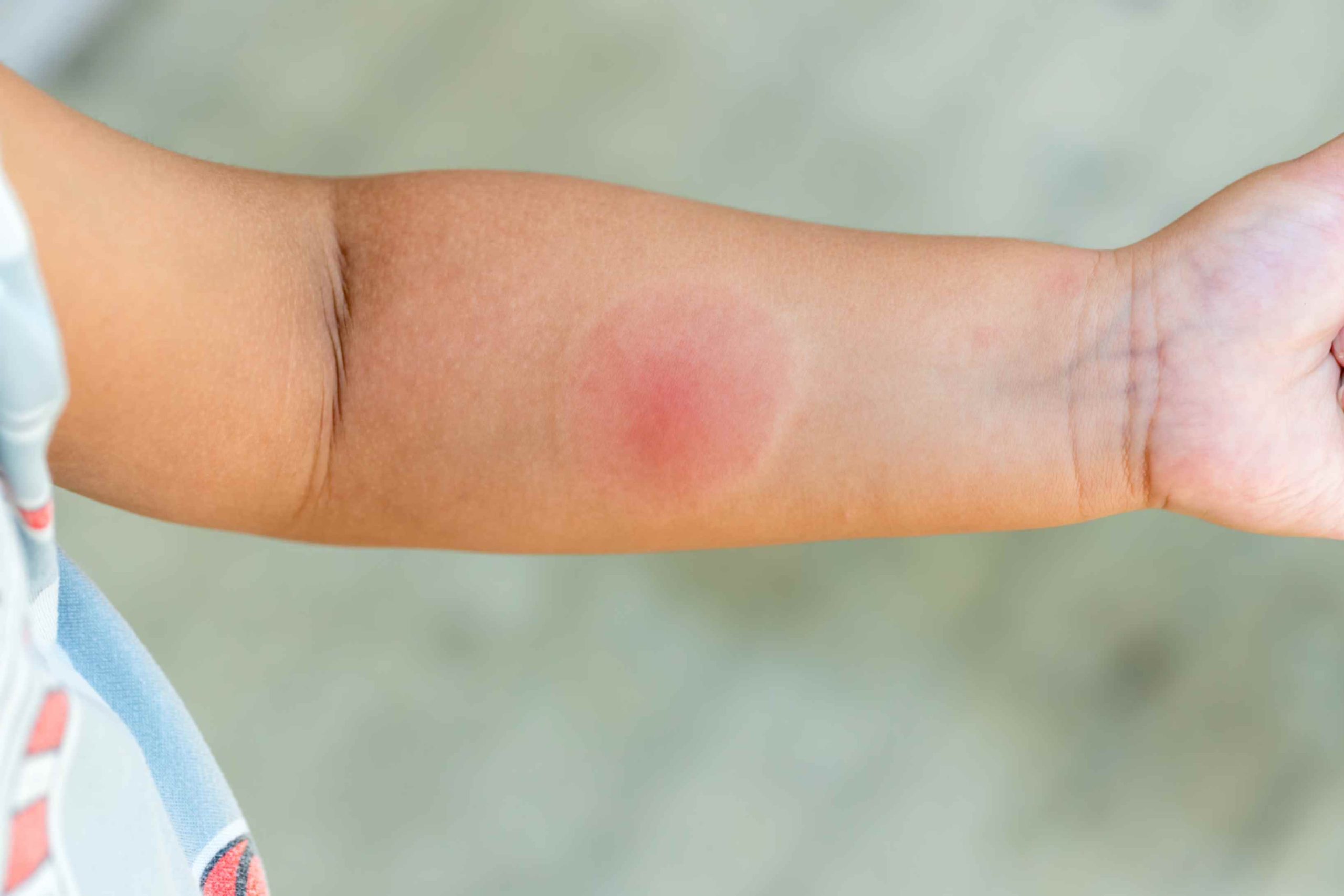 how to tell if an insect bite is infected