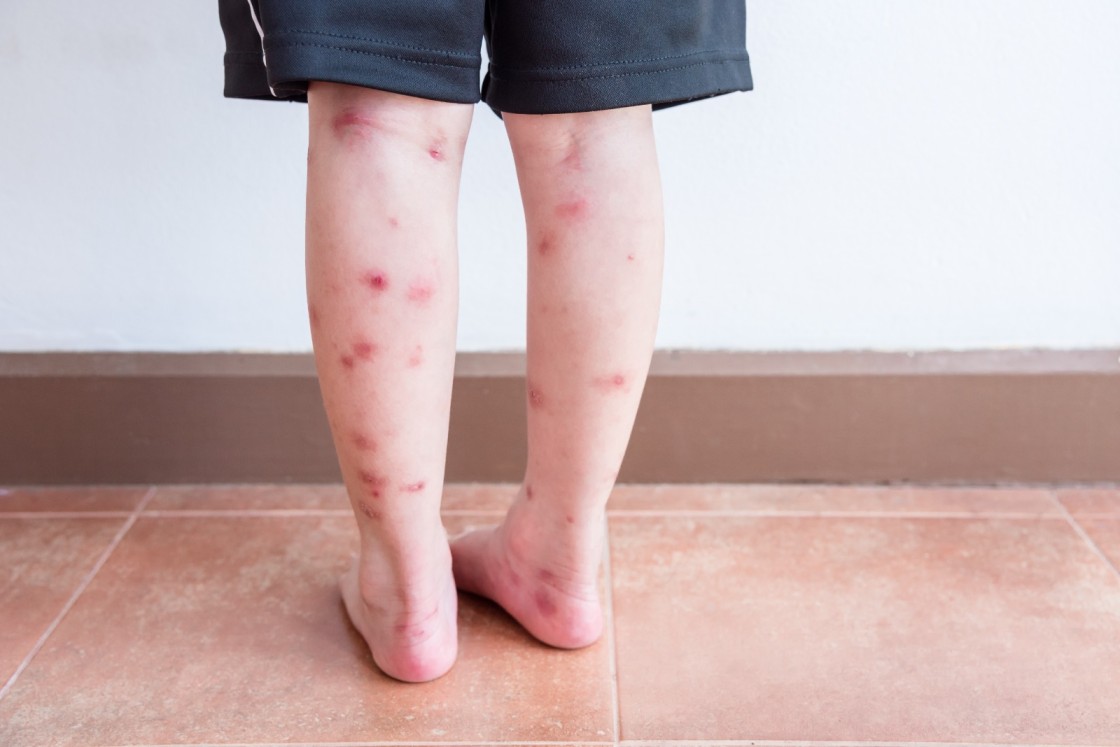 cleaning an insect bite to prevent infection