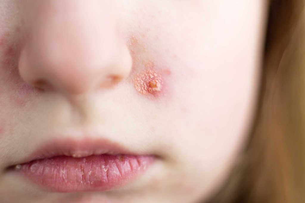 impetigo vs ringworm differences