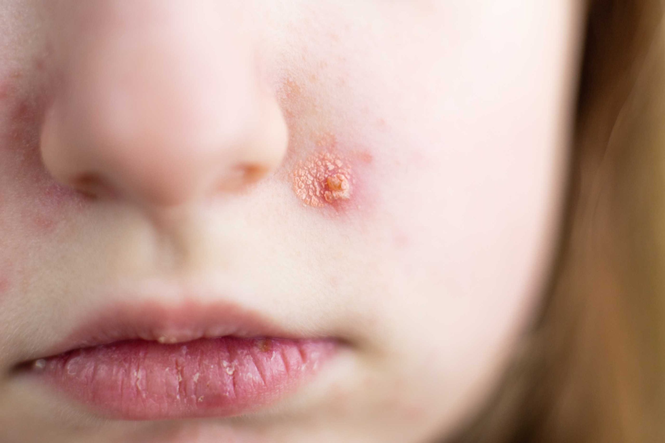 impetigo vs ringworm differences